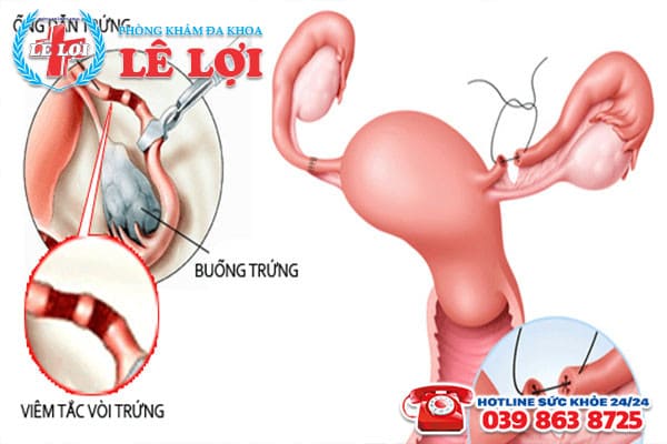 Hình ảnh về hiện tượng viêm tắc vòi trứng nữ giới