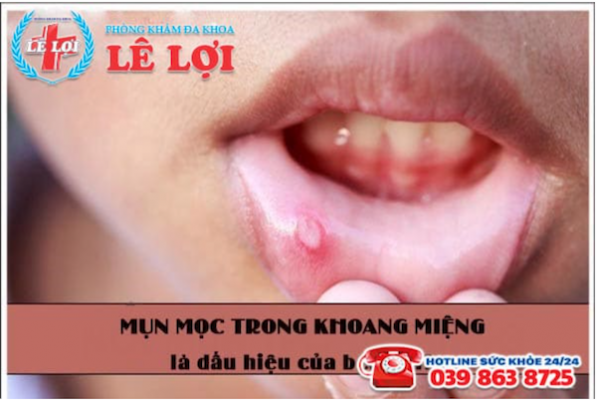 Mụn mọc trong khoang miệng là dấu hiệu của bệnh gì?