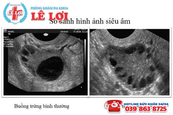 Các hình ảnh siêu âm buồng trứng đa nang ở nữ giới