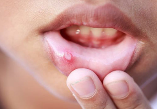 Cách chữa trị nốt trắng trong miệng